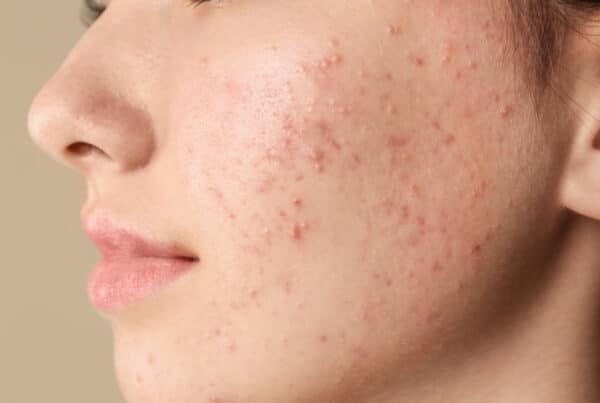 Common Skin Conditions