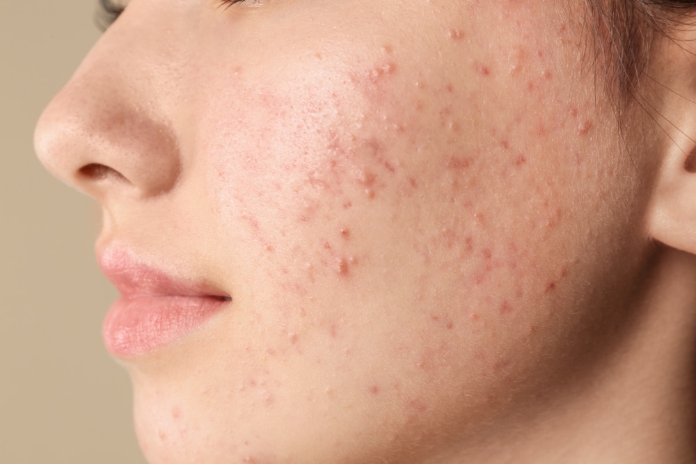 Common Skin Conditions