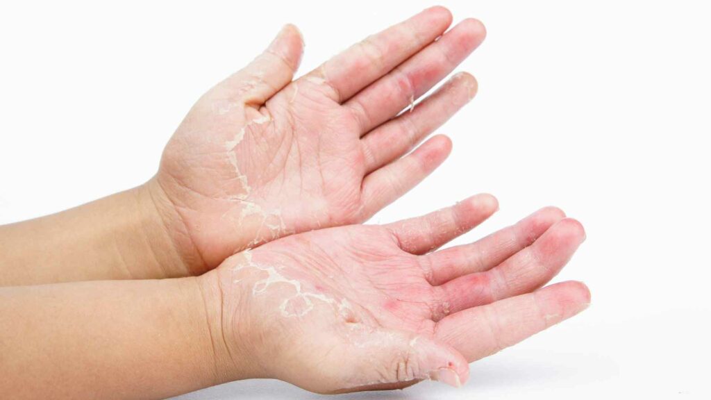 allergic contact dermatitis prevention treatment and how can compounding help