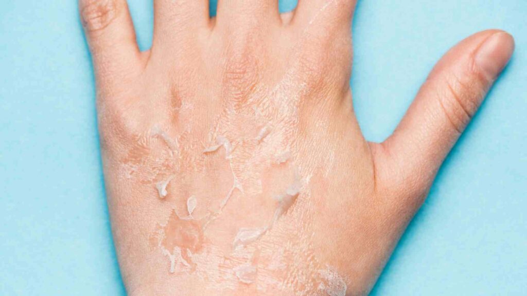 why treat your winter dry skin with compounded topical creams