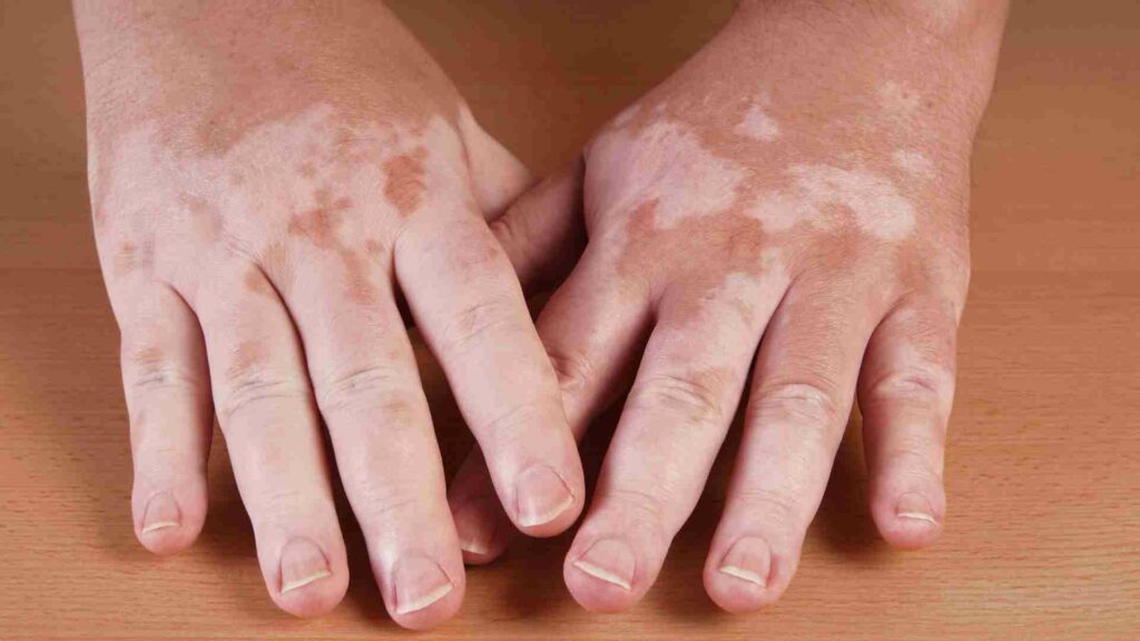breaking barriers compounding pharmacys role in treating vitiligo