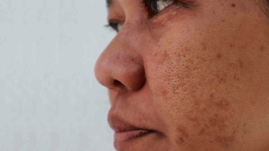 compounded medications for the treatment of melasma