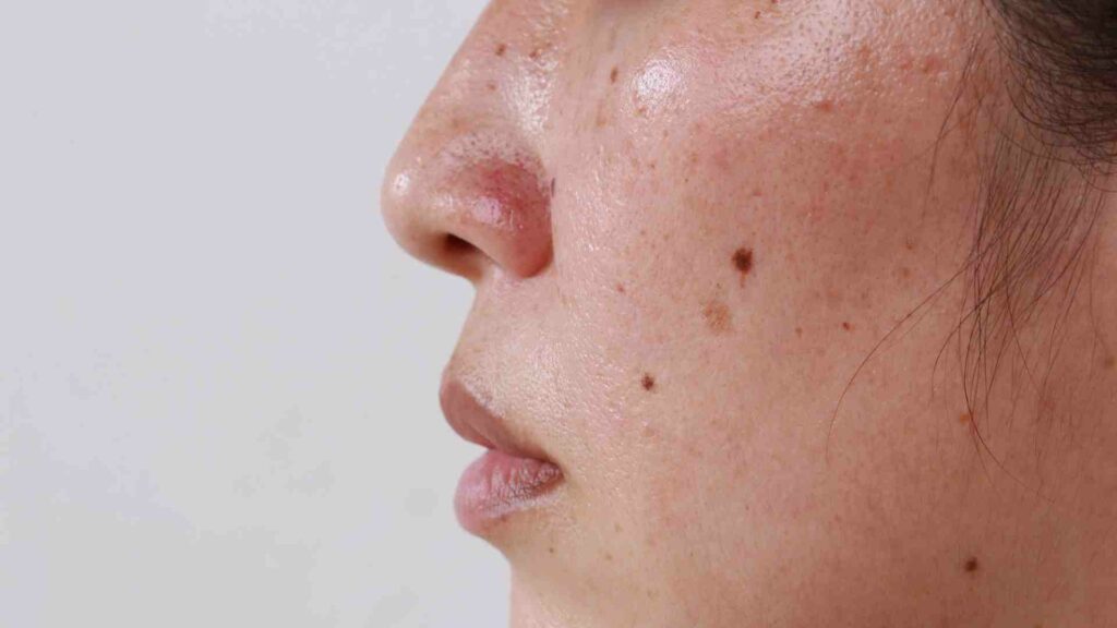 hyperpigmentation and your skin addressing dark spots using customized medicine