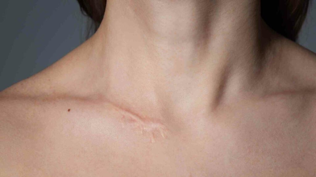 exploring the use of compounded gels for scar reduction