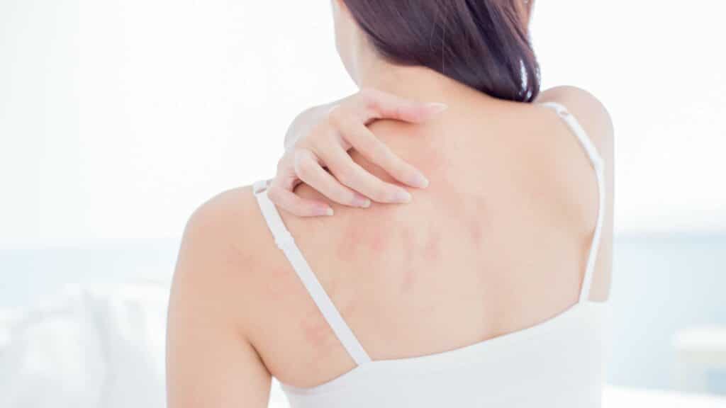 basics of eczema a comprehensive guide