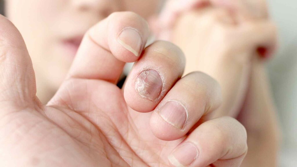 living with nail psoriasis practical tips for daily management